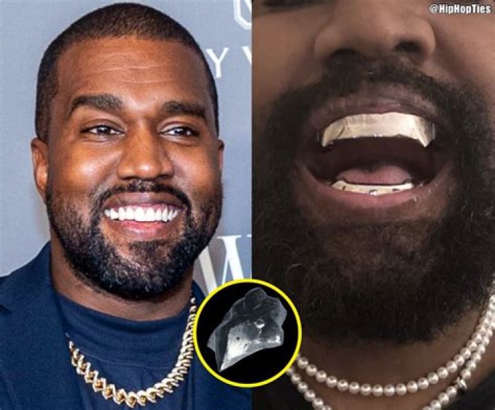 Kanye West Replaces His Teeth With Full Set of $850k Permanent Titanium Teeth